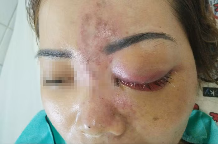 Kinh hoàng những trường hợp mù mắt vì tiêm filler nâng mũi liên tiếp xảy ra - Hình 3 Kinh hoang nhung truong hop mu mat vi tiem filler nang mui lien tiep xay ra-Hinh-3