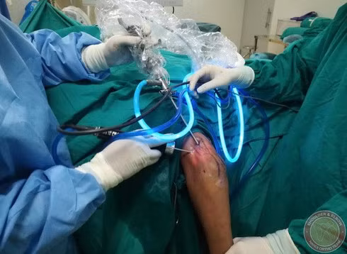 Kinh hoàng 200 "hạt trân châu" trắng sữa lổn nhổn trong khớp tay nam thanh niên - Hình 2 Kinh hoang 200