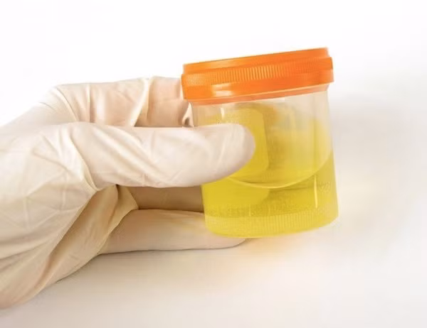 Gan và thận có vấn đề: Khi chức năng gan thận kém sẽ khiến hàm lượng protein hoặc bilirubin trong nước tiểu tăng lên nó sẽ thể hiện bằng các bong bóng.