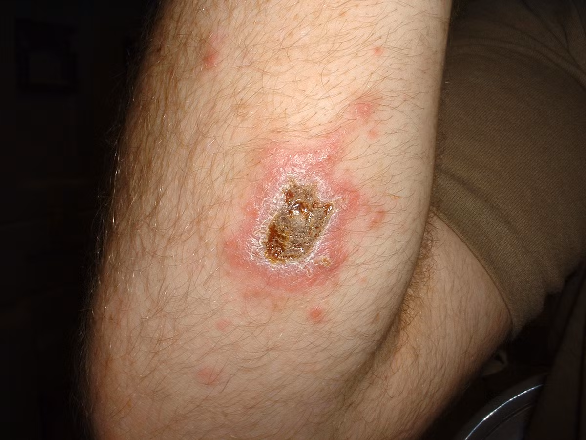 Có nhiều loại leishmaniasis, trong đó phổ biến nhất là leishmaniasis da gây lở loét và leishmaniasis nội tạng phá hủy lá lách, gan, tủy xương. Thông thường, thời gian ủ bệnh khoảng từ 3 đến 6 tuần. Ban đầu ở vết ruồi đốt sẽ xuất hiện nốt sần đỏ sau chuyển thành mụn loét có bờ nổi lên lởm chởm, đáy lõm sâu có mô mọc thành hạt, xung quanh là vùng da dày, cứng.