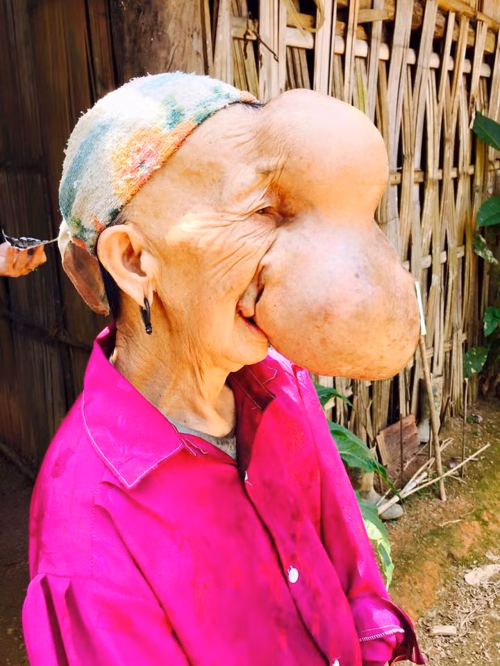 Qua nhiều năm, dịch từ não tủy cứ tiết ra qua khe trán mũi khiến khối u của bà to dần lên và làm biến dạng khuôn mặt.