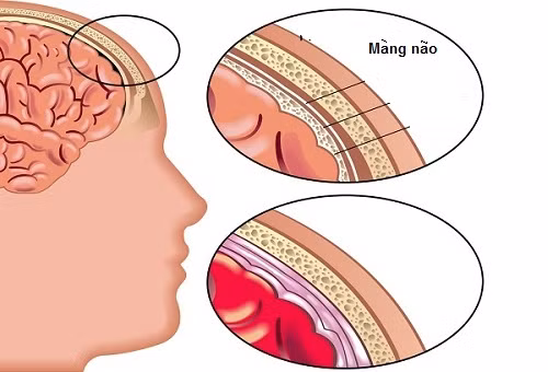 Sau khi khám ban đầu, Phó giáo sư, tiến sĩ Trịnh Đình Hải, Viện trưởng Viện Răng Hàm Mặt trung ương nhận định có thể bà Chài bị chứng thoát vị dịch não tủy. Đây là loại bệnh không hiếm gặp trên thế giới ở cả người và động vật. Nhưng đây là trường hợp đầu tiên Viện nhận bệnh nhân bị biến dạng khuôn mặt nhiều đến như thế.