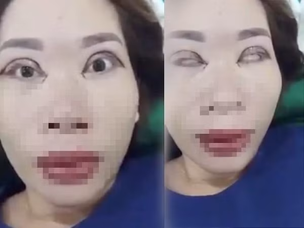 Trước đó, mạng xã hội cũng từng xôn xao trước trường hợp cắt mí của một chị khách hàng trung niên. Ngay sau khi đoạn clip quay cận cảnh mí mắt sau khi tiểu phẫu xong, cộng đồng mạng và cả nhân vật chính cũng không thốt nên lời.