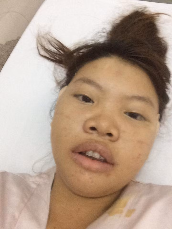Khuôn mặt của bà mẹ trẻ ở Đăk Nông sau khi phẫu thuật hạ gò má và cắt hàm hô.