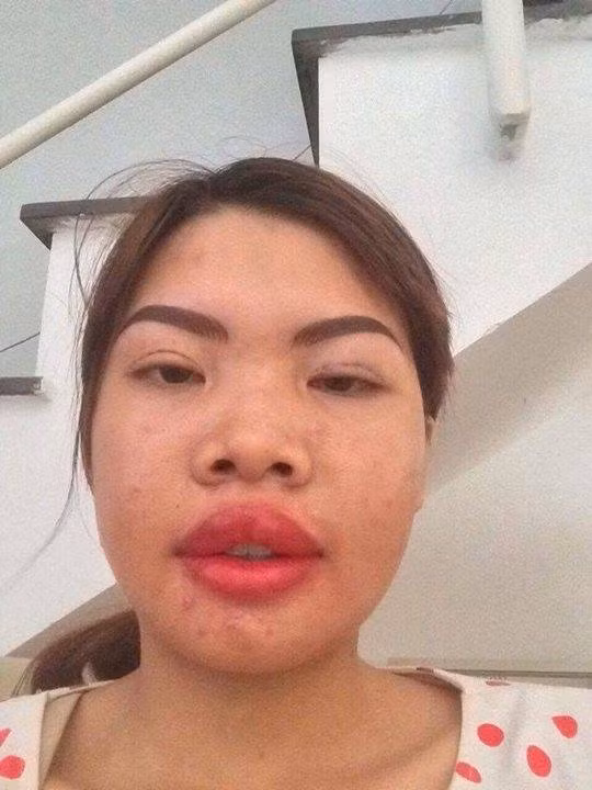 Quách Phượng gây nhiều chú ý trong hai tháng trở lại đây kể từ sau khi lên mạng trải lòng về quá khứ tủi nhục vì khuôn mặt xấu xí. Nỗi đau đó là động lực khiến cô liều lĩnh chi gần 200 triệu đồng để "đập đi xây lại" toàn bộ khuôn mặt với mong muốn sẽ đổi đời.