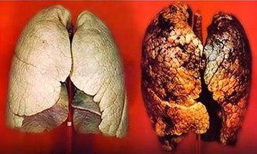 Ung thư phổi là bệnh ung thư phổ biến hàng đầu ở nước ta