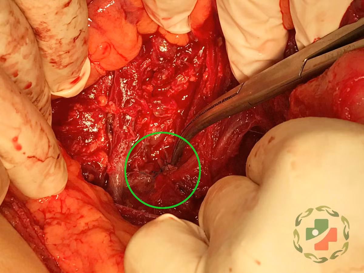 Bác sỹ CKI Vương Ngọc Chắt thăm khám cho bệnh nhân sau mổ