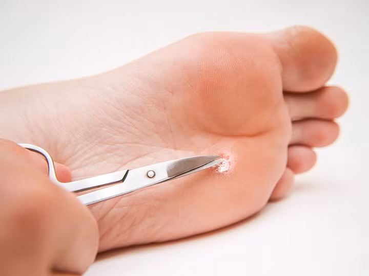 Cắt mụn cóc: Một số người sử dụng kéo, dao hoặc các dụng cụ sắc nhọn khác để cắt đứt mụn cóc. Bạn không nên làm điều đó vì sẽ gián tiếp khiến vết thương bị nhiễm trùng. Có những phương pháp tại nhà an toàn hơn khi xử lý mụn cóc chẳng hạn như lá tía tô, tỏi, chuối hay giấm táo.