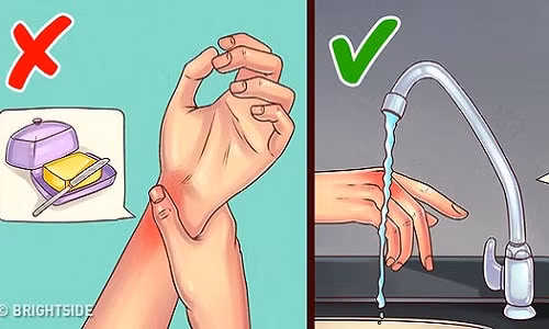 Chữa bỏng; Nhiều người có thói quen khi bị bỏng thường bôi lớp bơ hoặc dầu lên vết thương. Tuy nhiên, chính điều này làm vết bỏng lâu dịu hơn. Biện pháp tốt nhất là bạn nên làm mát vết thương bằng nước sạch, lạnh.