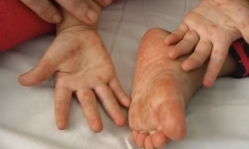 Bệnh tay chân miệng: Chủng virus EV 71 có thể gây chết người Benh tay chan mieng: Chung virus EV 71 co the gay chet nguoi
