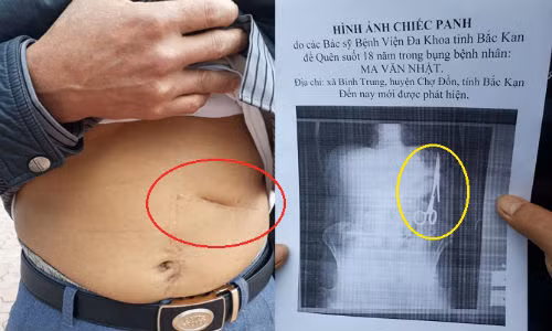 Xác nhận bác sĩ quên kéo trong bụng bệnh nhân 18 năm là có thật Xac nhan bac si quen keo trong bung benh nhan 18 nam la co that