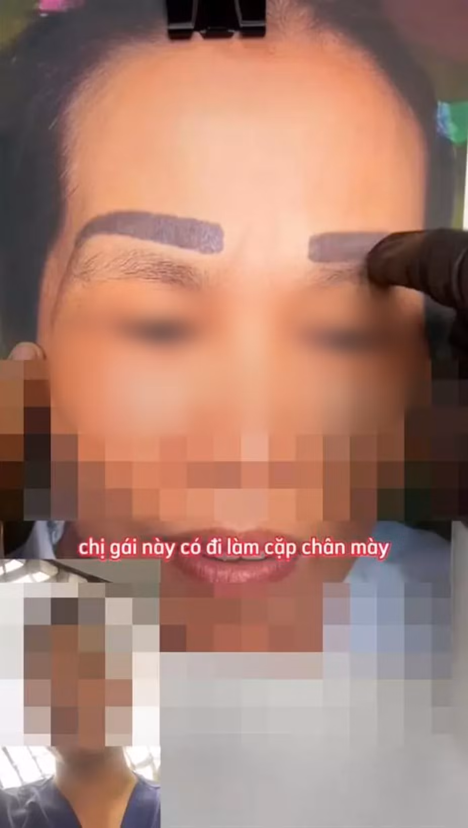 Mới đây trên mạng xã hội liên tục bàn tán về ca làm đẹp của một người phụ nữ. Theo thông tin đăng tải, chị này muốn xăm lông mày cho mặt thanh thoát hơn.
