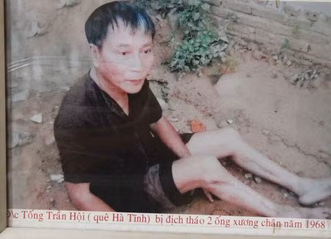Ông Hội bị cai ngục rút mất 2 xương ống chân.
