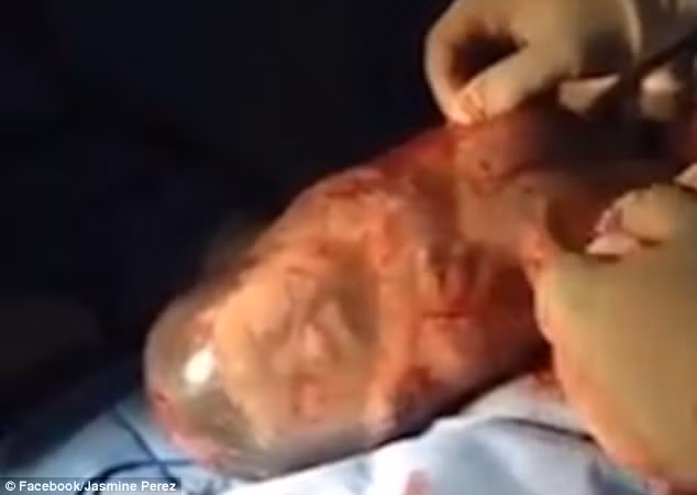 Điều đặc biệt hơn nữa là đây là ca sinh ba, hai em bé kia chào đời bình thường còn bé này thì nằm nguyên trong bọc nước ối. Em bé càng ngày càng cử động nhiều như thể muốn chui ra ngoài gặp người thân. 