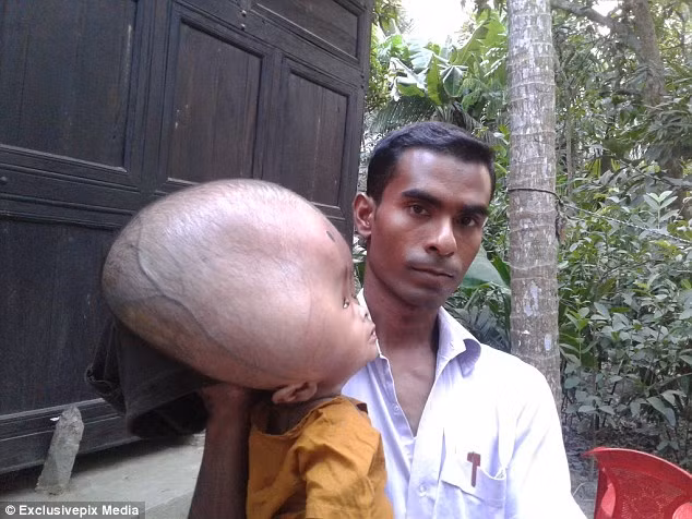 Phải mất một thời gian dài thì bé Emon mới được chẩn đoán là mắc bệnh não úng thủy khiến phần sọ bị tích nước, tăng áp lực lên não và ảnh hưởng đến não. Ở người bình thường, não và xương sống được dịch não tủy bao quanh để cung cấp chất dinh dưỡng đồng thời loại bỏ những chất cặn bã. Dịch não tủy liên tục được não và xương sống sản xuất ra (khoảng gần 600ml/ngày), phần dịch não tủy cũ sẽ được não thải loại qua các mạch máu. Tuy nhiên, khi quá trình này bị gián đoạn, dịch não tủy bị ứ đọng gây áp lực cho não.