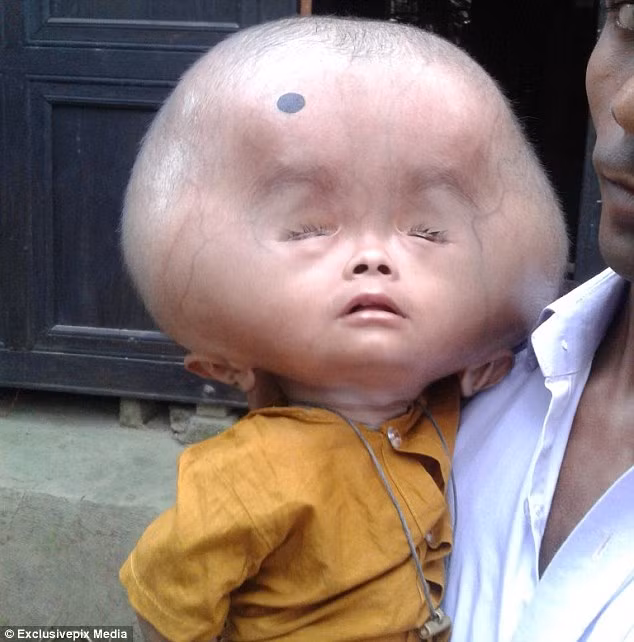 Một bé trai hai tuổi tên Emon tại Bangladesh có phần đầu khổng lồ nặng tới 9kg – tương đương với cân nặng trung bình của em bé một tuổi.