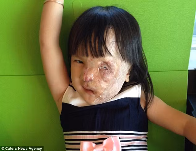 Sau 2 tháng trời cùng nhau tại Tây Ban Nha, hai bà mẹ nhanh chóng có mối quan hệ khăng khít với nhau. Vì cả hai đều không nói được tiếng của người kia nên họ giao tiếp với nhau bằng một phần mềm ipad. Bé Nguyệt sẽ tiếp tục được phẫu thuật thêm lần nữa để trị sẹo và cải thiện mí mắt và bà Maxey vẫn đang tiếp tục kêu gọi sự trợ giúp của các nhà hảo tâm.
