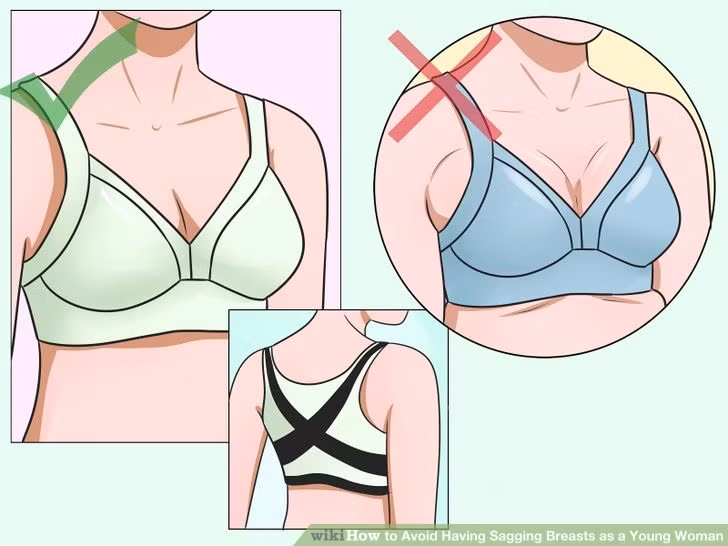 Ngực chảy sệ: Có hai nguyên nhân chính dẫn đến ngực chảy sệ là sụt cân và cho con bú. Trong cả hai trường hợp, ngực đều bị thu nhỏ kích thước, nhất là phần bầu ngực phía trên, khiến đầu ngực sa xuống dưới.