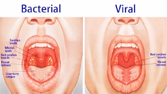 Tuy cắt amiđan là một phẫu thuật nhỏ nhưng chỉ nên cắt amiđan nếu bị viêm kéo dài hoặc hay tái phát, hoặc những người có amiđan to ảnh hưởng nghiêm trọng đến sinh hoạt hàng ngày và giấc ngủ như ngủ ngáy, ngưng thở khi ngủ, khó nuốt…