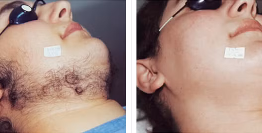  “Nếu kỹ thuật viên thực hiện thao tác triệt lông bằng laser không được đào tạo hợp lý hoặc không được trang bị đầy đủ thì cả kỹ thuật viên và khách hàng đều sẽ gặp nguy hiểm. Vì vậy chỉ nên tiến hành ở nơi thông thoáng khí có hệ thống hút mùi”. – Bác sĩ Chuang cho biết. 
