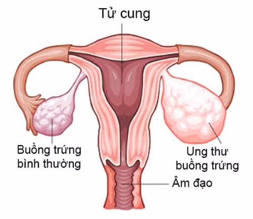 Mặc dù bác sĩ sản khoa khuyến cáo phụ nữ không nên thụt rửa vùng kín nhưng rất nhiều phụ nữ vẫn thực hiện thói quen xấu này vì hiểu lầm rằng càng thụt rửa thì vùng kín sẽ càng sạch sẽ hơn. Trong số những người tham gia nghiên cứu nói trên có 154 trường hợp bị ung thư buồng trứng và kết quả cho thấy những người từng vệ sinh vùng kín không đúng cách như trên có nguy cơ ung thư cao gấp đôi. 