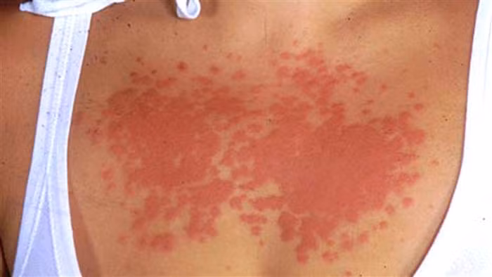 Phát ban vì nhiệt có thể xảy ra ở người lớn trong điều kiện thời tiết nóng ẩm do lỗ chân lông bị bít lại và da không thở được. Triệu chứng từ nhẹ là bị rộp da đến nặng là các vết đỏ sâu. Phần da bị phát ban sẽ rất ngứa và châm chích. Hiện tượng bệnh do nắng nóng này có thể nhanh chóng biến mất khi da được làm mát. Nếu bị nặng thì cần dùng các loại thuốc mỡ bôi. Các loại kem có chứa calamine (quặng kẽm) cũng có tác dụng làm dịu vết ngứa và mỡ cừu khô sẽ ngăn tổn thương lan rộng.