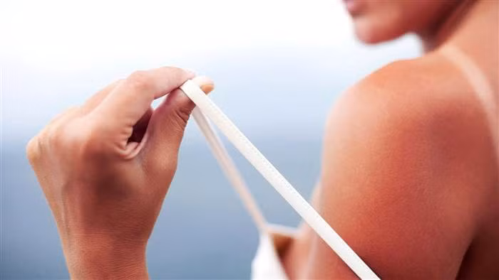 Bạn sẽ bị cháy nắng khi da bị phơi dưới tia UV, dù là trực tiếp hay gián tiếp. Những người da càng sáng màu thì càng nên cẩn trọng vì dễ bị cháy nắng dù chỉ ở ngoài trời trong thời gian ngắn. Cháy nắng hoặc ngộ độc nắng cũng khiến da bị tổn thương như nhau nhưng ngộ độc nắng là bệnh khi đi bơi hoặc đi biển cần được chú ý hơn. 