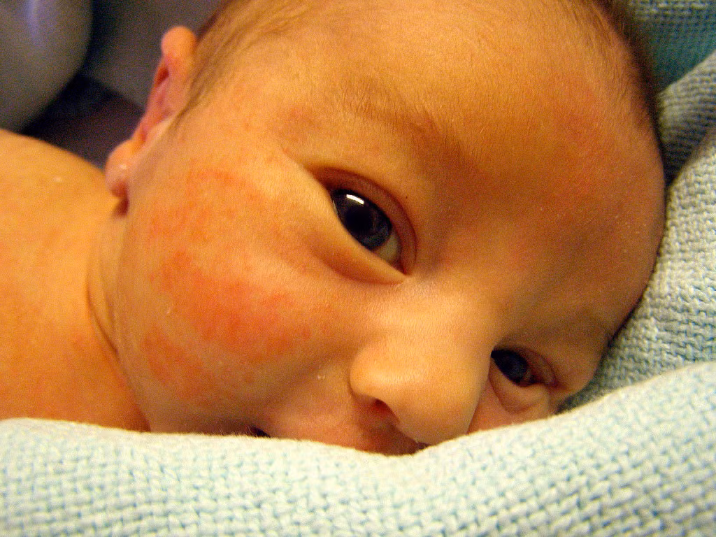 Nếu bé đang phải chống chọi với bệnh chàm bội nhiễm (eczema), hãy dùng dầu dừa thay vì các loại thuốc chứa steroid. Dầu dừa có tác dụng chống viêm sưng nên làm bé đỡ khó chịu.