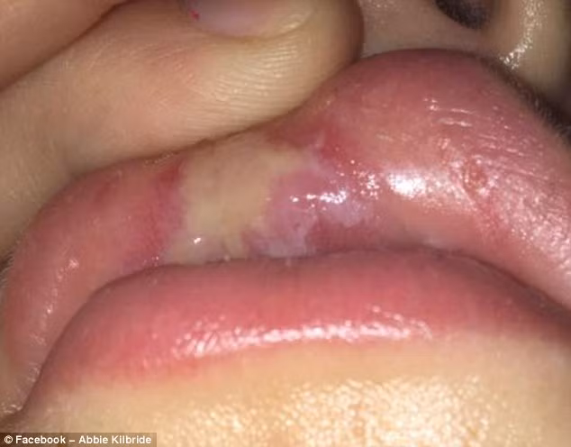 Đi khám đa khoa và tiếp tục được kê antihistamine, tình trạng của Abbie không những không giảm mà vết rộp màu vàng ngày càng nặng hơn, Abbie mới quyết định đi khám nha khoa ở bệnh viện và được cho biết môi cô bị bỏng độ 3. Cô chỉ ăn được súp và trứng cho đến khi khỏi bệnh.