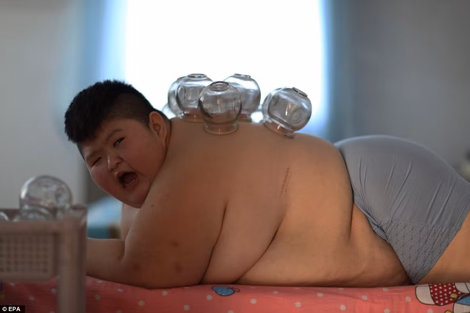 Một cậu bé mới 11 tuổi nhưng nặng tới 146kg đang được điều trị giảm cân bằng một số phương pháp y học cổ truyền Trung Quốc, trong đó có một phương pháp rất nguy hiểm và đáng sợ là dùng lửa đốt mỡ bụng. Cậu bé tên Li Hang này mắc hội chứng Prader-Willi, một rối loạn về gien hiếm gặp gây ám ảnh với ăn uống, khó tiếp thu và phát triển bất thường. 