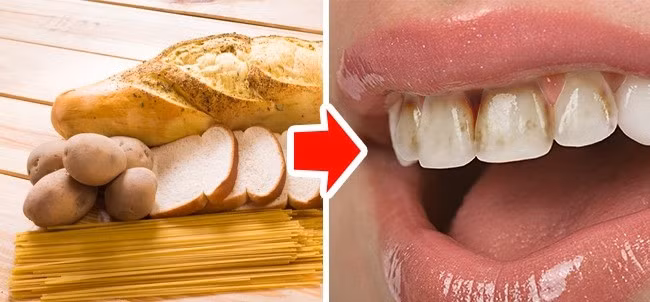 Bánh mì, mì ống và khoai tây: Những thực phẩm giàu tinh bột này sẽ bám vào răng và ở trong miệng trong thời gian dài, tăng hình thành mảng bám. Ngoài ra, tinh bột còn biến thành đường khi có nước bọt, dẫn tới sâu răng và các vấn đề răng miệng khác.
