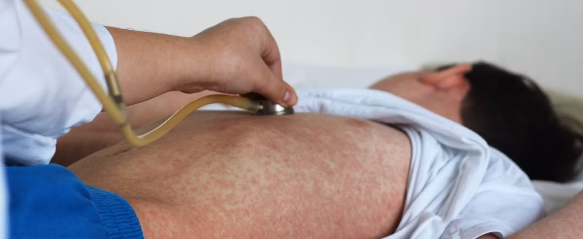 Cả nước thêm 2 ca tử vong do mắc sởi trong tuần qua Ca nuoc them 2 ca tu vong do mac soi trong tuan qua