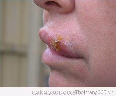 Việc vệ sinh sau khi quan hệ không thể loại bỏ được yếu tố nguy cơ lây nhiễm sùi mào gà.