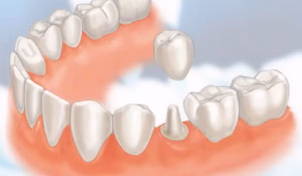 Vào những năm 1800, răng giả được làm từ răng của những người lính chết trận.