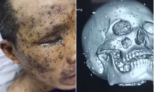 Hình ảnh chụp cắt lớp cho thấy trên mặt bệnh nhân chi chít các mảnh nhọn