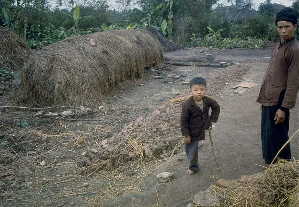 Một em bé ở khu vực ngoại ô bị mất chân do bom Mỹ đứng cùng bố trên đường làng. Em sử dụng một khúc cây làm nạng.