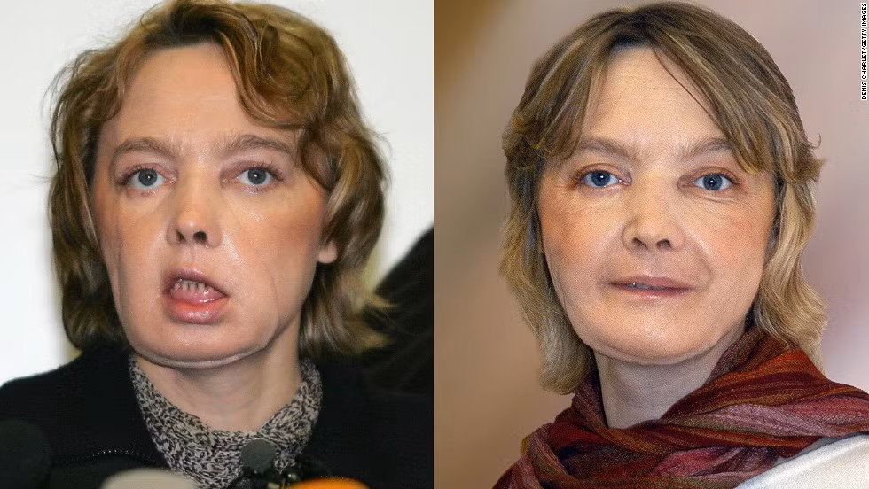 Isabelle Dinoire (39 tuổi - người Pháp) là người đầu tiên được ghép mặt năm 2005 sau khi bị một con chó tấn công và làm biến dạng khuôn mặt. Vài tháng sau đó, cô được các bác sĩ phẫu thuật để có gương mặt hoàn thiện hơn.
