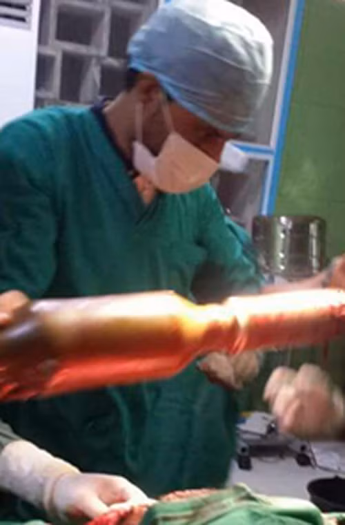 Truyền thông Ả Rập mới đây đã công bố thông tin kèm hình ảnh gây “sốc”, theo đó một chiến binh nhóm vũ trang Ansar al-Sharia ở Yemen đã bị một khẩu súng chống tăng RPG-32 bắn trúng. Viên đạn đã đâm sâu vào phần đùi, mông anh này, nhưng may mắn là không nổ. Các bác sĩ đã gắp thành công viên đạn này ra khỏi người anh chàng may mắn nhất năm.