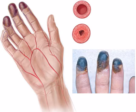 Biến chứng của bệnh tiểu đường bao gồm hoại tử khiến hệ thống miễn dịch cơ thể yếu và dễ bị nhiễm trùng. Hoại tử thường xảy ra ở chân người bệnh, là những vết chai sau đó thành các nốt loét và ăn sâu vào thịt, tấn công vào xương và tủy. Nếu không được phát hiện sớm có thể phải cắt bỏ chân.