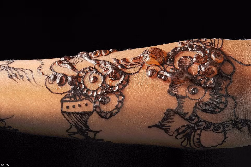Bức ảnh này cho thấy một hình xăm henna trên cánh tay của một cô gái trẻ. Cô có mụn nước trên tay cô ấy vì cô bị dị ứng với thuốc nhuộm. Những mụn sẽ chữa lành nhưng thật đáng buồn chúng có thể để lại dấu vết trên da.