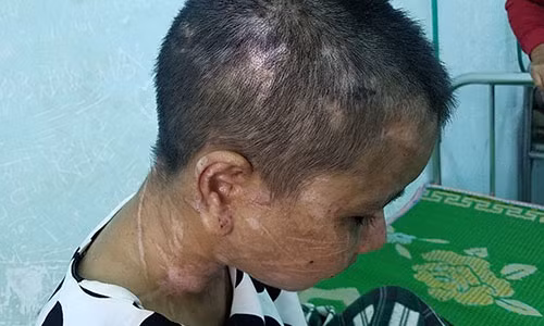 Khuôn mặt chị Y Nhiêu với chi chít vết sẹo. Ảnh Đình Văn