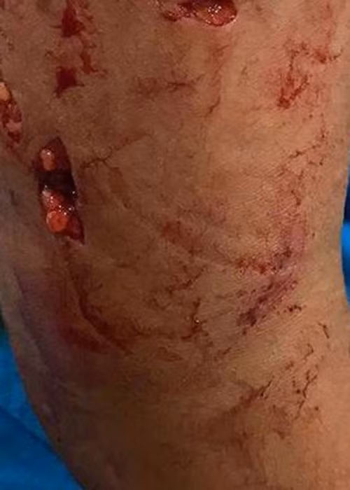 Một phần cánh tay của cháu bé bị chó cắn- Ảnh từ FB BS. Ngô Đức Hùng Một phần cánh tay của cháu bé bị chó cắn- Ảnh từ FB BS. Ngô Đức Hùng