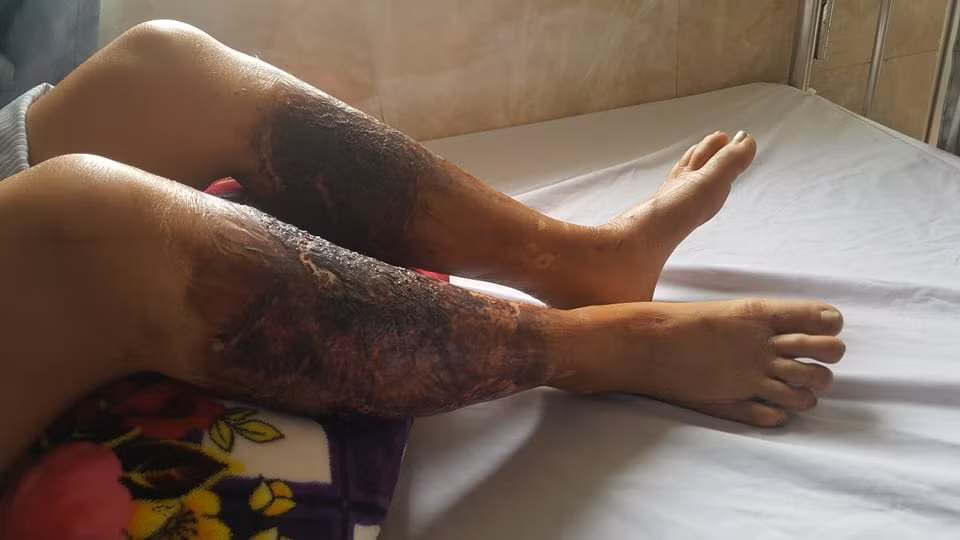 Theo lời bà Lan, vào sáng 8/5, bà cùng 2 người trong thôn ra đồng bắt cua. Khi đó, bà Lan mặc quần vải, 2 người còn lại mặc quần ủng bằng cao su. Ba người cùng lội qua con mương nhỏ có nước màu đen. Khi lội qua ống quần bà Lan bị dính bết chất màu đen hăng nồng. Về nhà, chân bà Lan bị phồng rộp, thâm đen và toàn thân phát sốt.