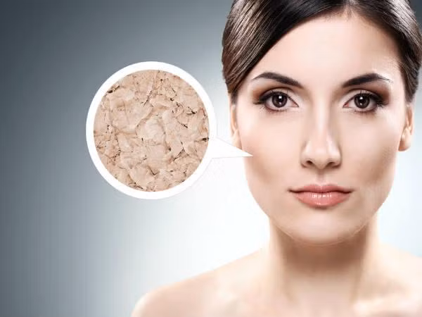 7. Da khô: Da khô thường xuyên dễ khiến bạn có nhiều nếp nhăn. Đây là một trong những lý do sức khoẻ khiến bạn có thêm nếp nhăn sớm trong cuộc đời. Ảnh: Boldsky.