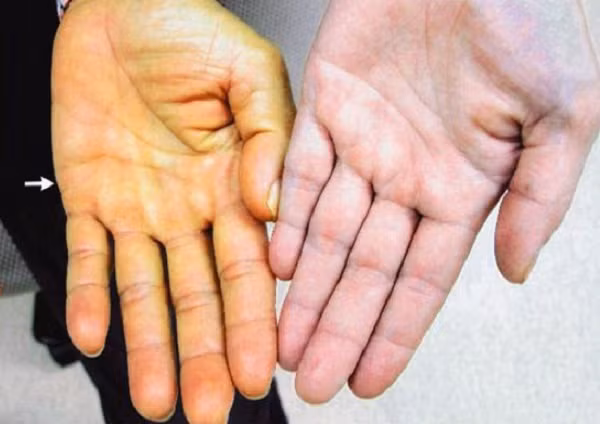Vàng da: Vàng da là do sự chuyển hóa bilirubin trong cơ thể gặp trở ngại, khiến nồng độ bilirubin trong máu tăng cao, xâm nhập vào các mô, nhuộm vàng màng cứng, màng nhầy và da. Khi gan nhiễm mỡ các kiểu vàng da thường là tế bào gan, kiểu vàng da này thường kèm theo các triệu chứng mệt mỏi, khó chịu, chán ăn. Số ít người gan nhiễm mỡ sẽ vàng da thể nhẹ, sau khi chất béo trong gan được loại bỏ, bệnh vàng da sẽ lập tức biến mất. Ảnh: Internet.