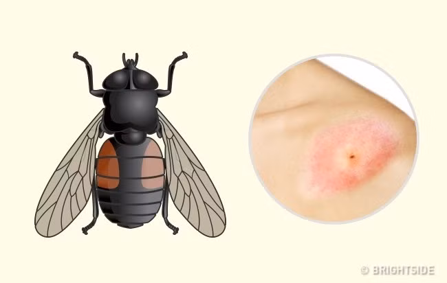 Ruồi trâu: Ruồi trâu là một loại ruồi lớn thường đốt và hút máu gia súc. Tuy nhiên, chúng cũng cắn người rất đau. Ban đầu, vết đốt nổi đỏ không quá 1mm. Sau đó, bắt đầu sưng lên và ngứa. Ruồi trâu thường truyền các bệnh khác nhau như bệnh tularemia (bệnh nhiễm khuẩn cấp tính do vi khuẩn francisella tularensis gây ra) và bệnh than, nhưng hầu hết chúng thường tấn công gia súc nhiều hơn con người. Ảnh: Brightside.