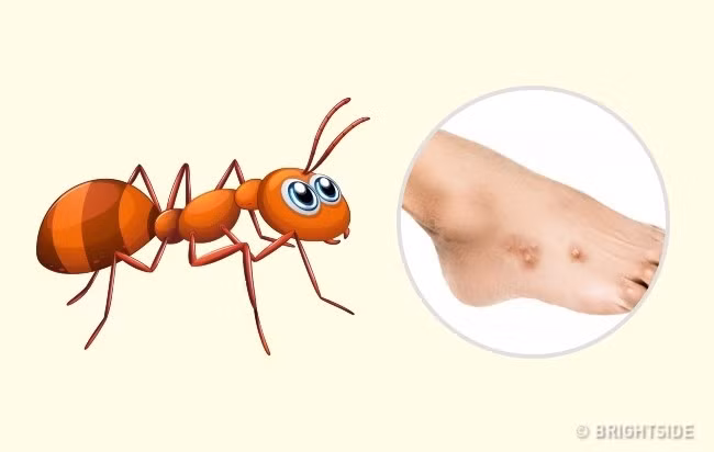 Kiến: Hầu hết các loài kiến không gây nguy hiểm cho người. Tuy nhiên, kiến lửa đỏ có thể gây nhiều rắc rối. Vết mụn mủ xuất hiện trên các vết cắn mà sau này sẽ biến thành vết sẹo. Vết cắn của kiến ít nguy hiểm hơn. Nó trông giống như vết muỗi chích. Một vết nhỏ màu hồng xuất hiện trong khu vực bị cắn gây ngứa trong một thời gian dài. Ảnh: Brightside.