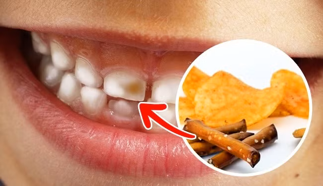 7. Bim bim: Các loại bim bim chứa carbohydrate nhanh chóng biến thành glucose dưới ảnh hưởng của nước bọt, hình thành những vết ố vàng trên răng. Sau khi bạn ăn bim bim, sẽ còn lại những mảng bám răng, do đó, đừng quên xúc miệng bằng nước sau khi bạn có một bữa ăn nhẹ. Ảnh: Pixabay.