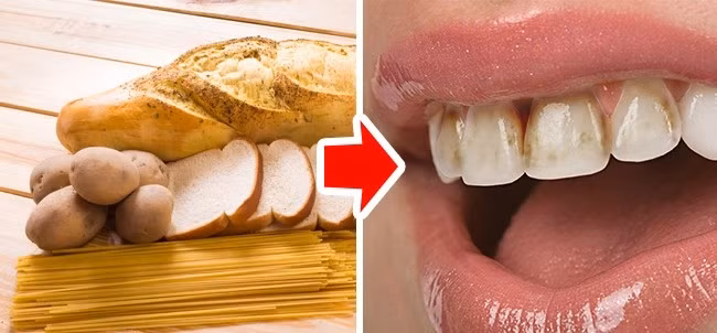 3. Bánh mì, mì ống, và khoai tây: Thực phẩm có chứa rất nhiều tinh bột dính vào răng và ở lại trong miệng trong một thời gian dài. Tinh bột gây ra sự hình thành một vùng mảng bám răng. Ngoài ra, tinh bột biến thành đường khi tiếp xúc với nước bọt. Điều này có thể dẫn đến sâu răng và các vấn đề nghiêm trọng khác. Ảnh: Pixabay.