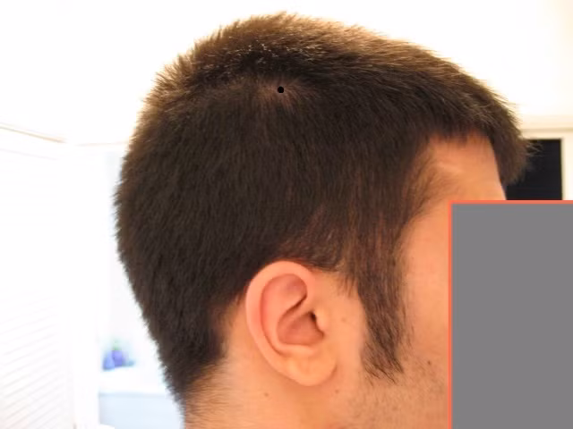 Nốt ruồi ở phía bên phải đầu là tướng của người nổi tiếng. Họ có nhiều cơ hội để nắm giữ những vị trí cao trong xã hội. Ảnh minh họa: Bald Truth Talk.